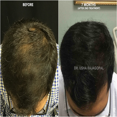 Acell PRP Treatment for Hair Loss Abu Dhabi