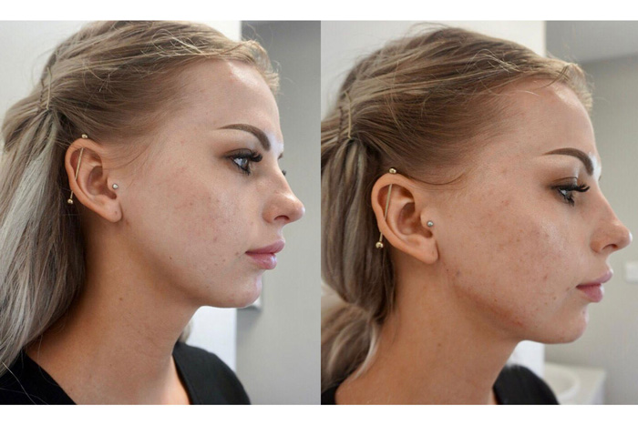 Jawline Contouring Abu Dhabi