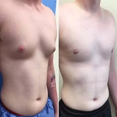 Lipo Chest Surgery Abu Dhabi