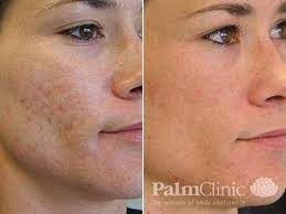 Microneedling for Acne Scars Abu Dhabi