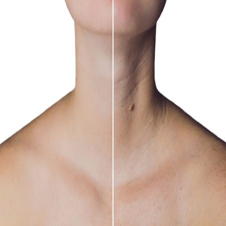 Botox For Neck Abu Dhabi