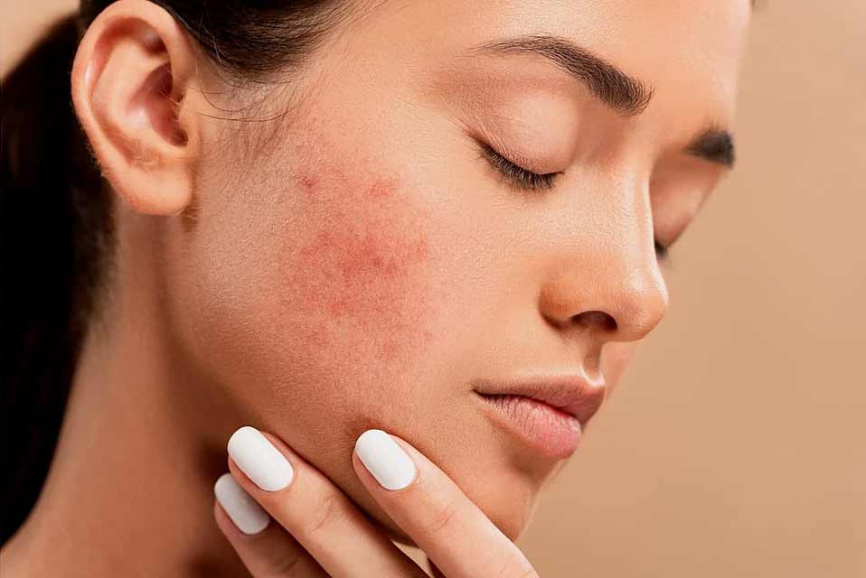 Pimples Treatment Abu Dhabi