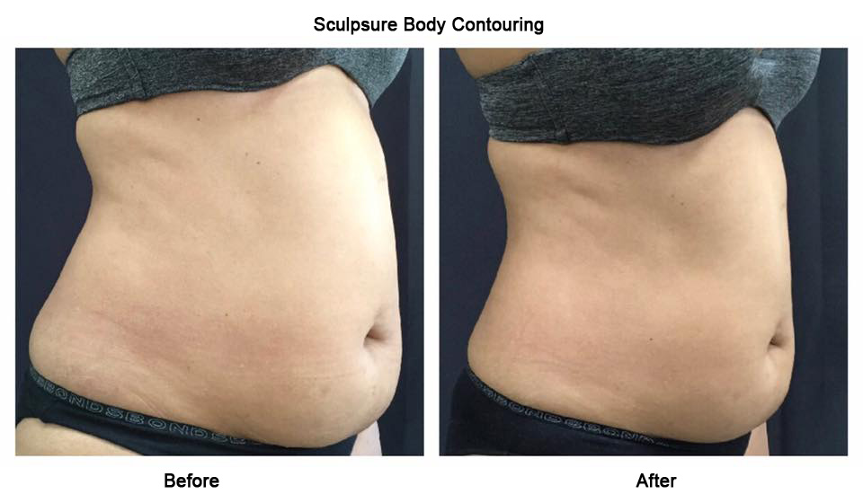 Sculpsure Body Controuring Abu Dhabi