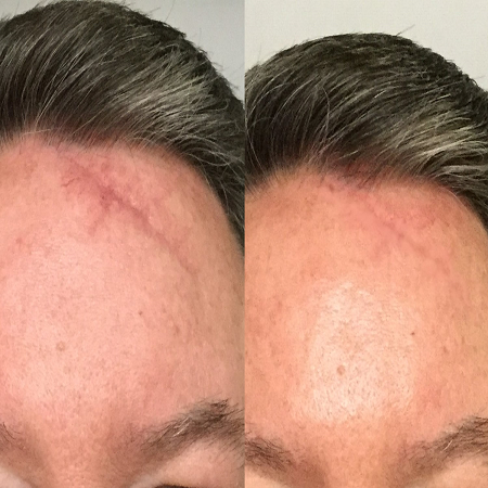 Surgical Scar Revision Abu Dhabi