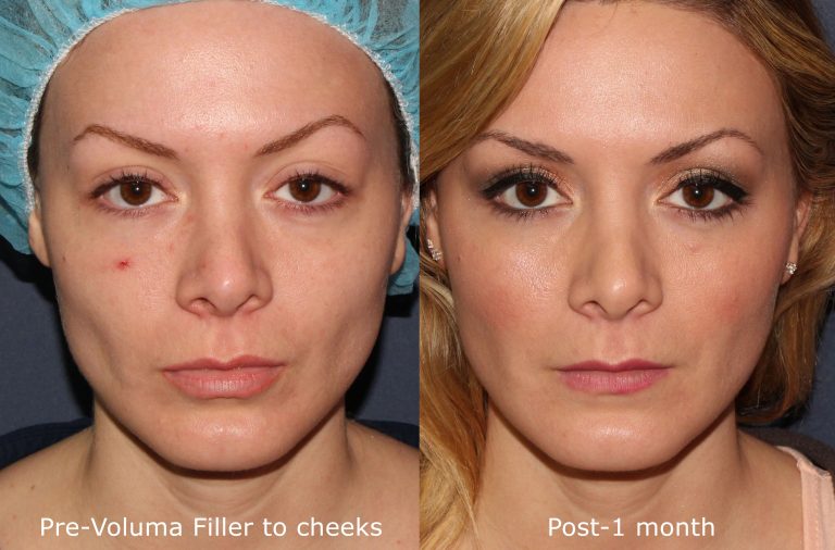 Voluma Fillers Abu Dhabi