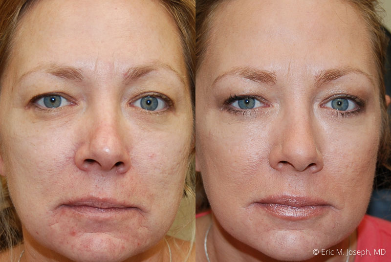 Xeomin Treatment Abu Dhabi