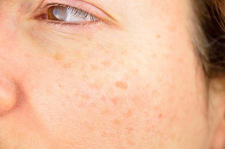 Actinic Keratosis Abu Dhabi