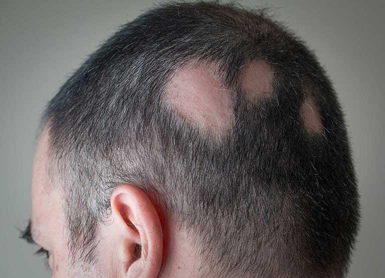 Alopecia Areata Treatment Abu Dhabi