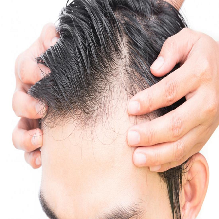 Baldness Treatment for Male Abu Dhabi