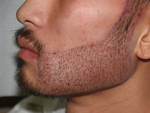 Beard Hair Transplant Abu Dhabi