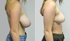 Breast Reduction Abu Dhabi