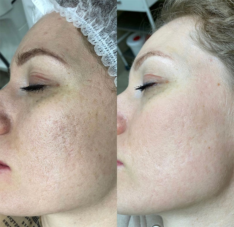 Laser Carbon Peel Abu Dhabi