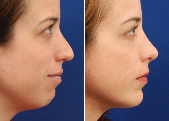 Chin Augmentation Abu Dhabi