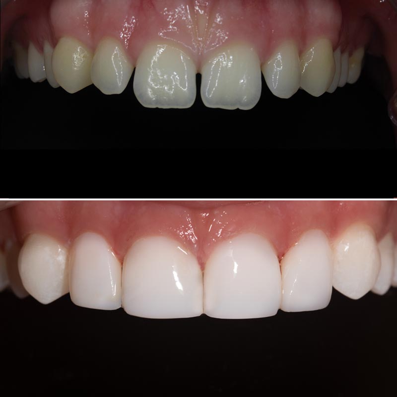 Composite Veneers Abu Dhabi