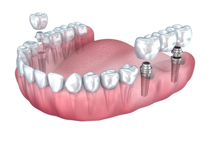 Dental Implants Abu Dhabi