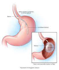 Endoscopic Intragastric Abu Dhabi