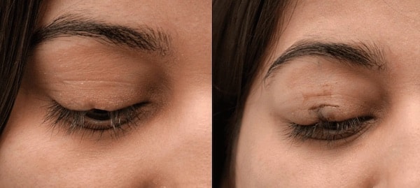 Eyelash Hair Transplant Abu Dhabi 