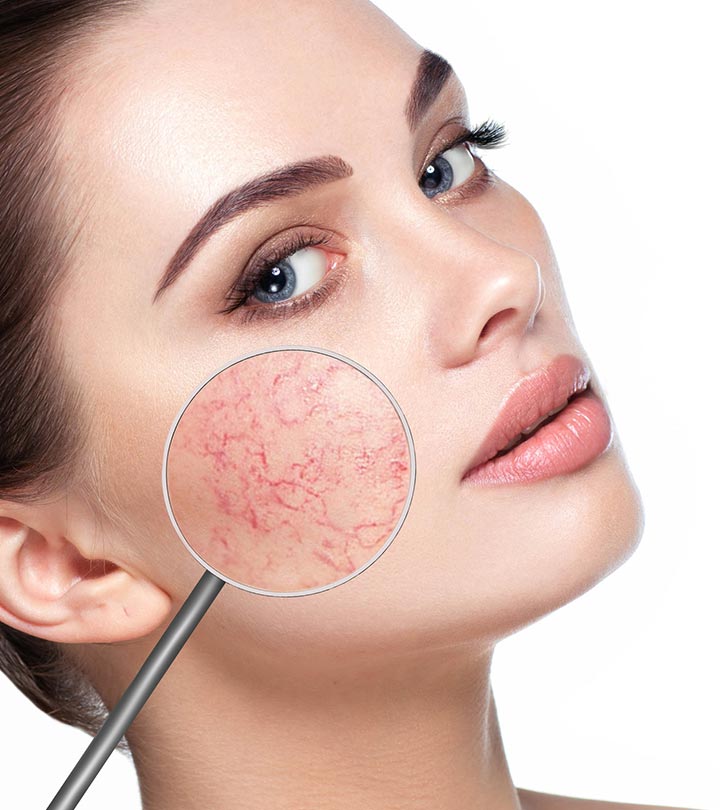 Facial Capillaries Treatment Abu Dhabi 