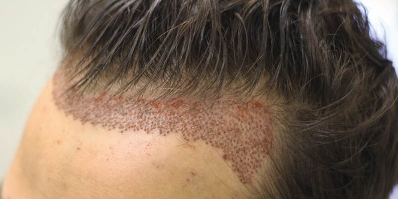 FUE Hair Transplant Abu Dhabi