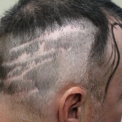 Fuss Hair Transplant Abu Dhabi