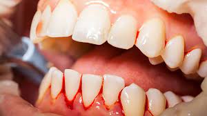 Gum Bleeding Treatment Abu Dhabi