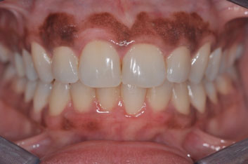 Gum Depigmentation Abu Dhabi