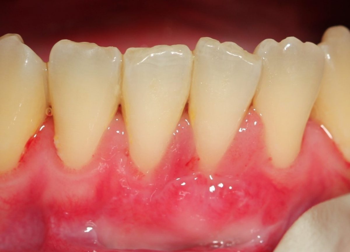 Gum Recession Treatment Abu Dhabi