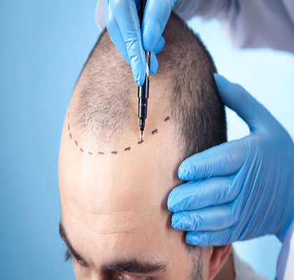 Hair Implants Clinic Abu Dhabi