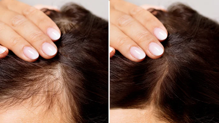 Hair Loss Treatment Abu Dhabi