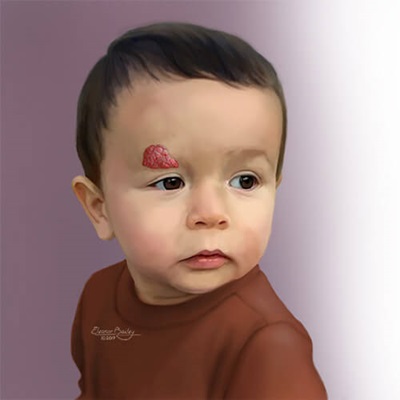 Hemangioma Treatment Abu Dhabi