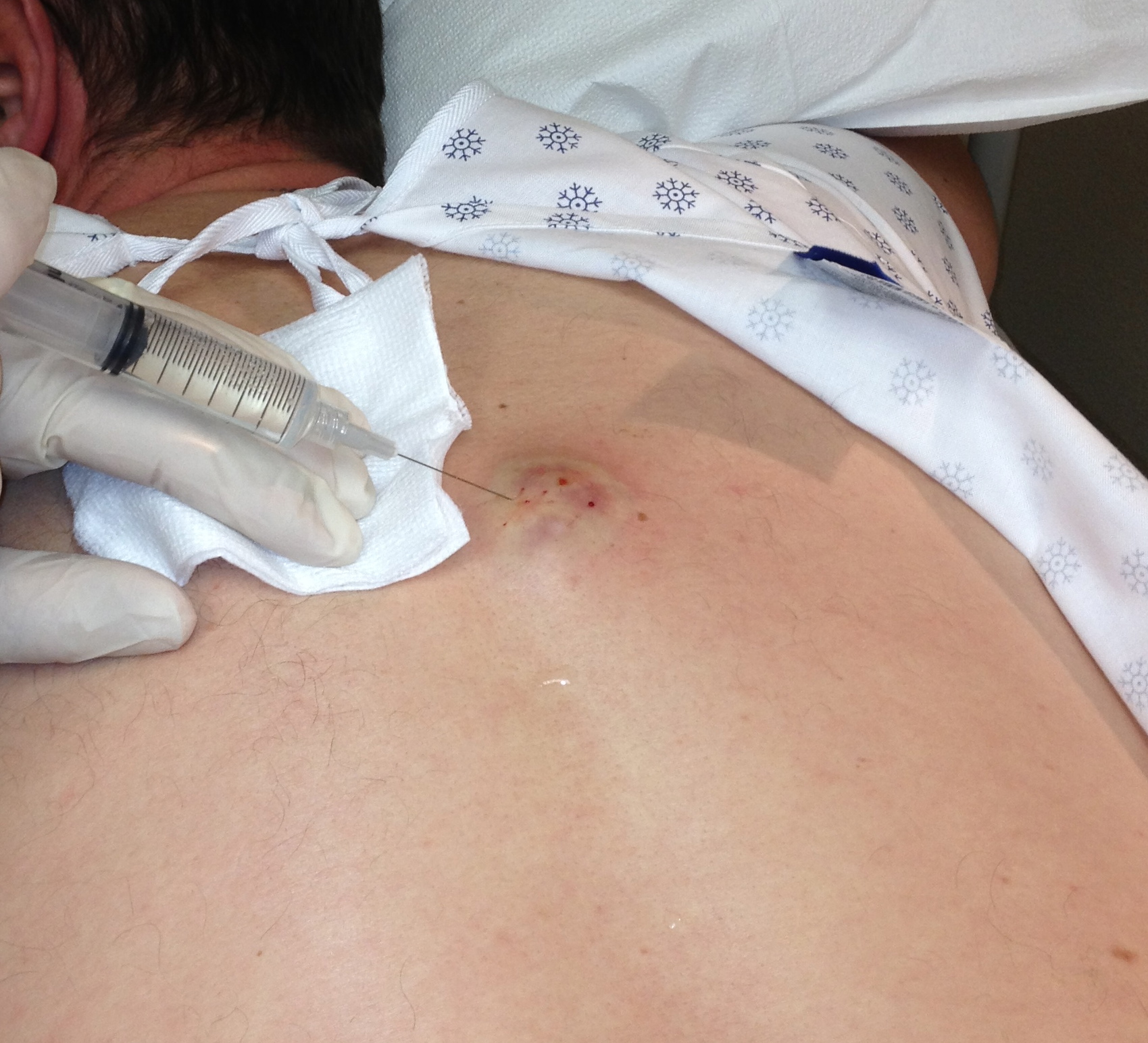Incision and Drainage of Abscesses Abu Dhabi