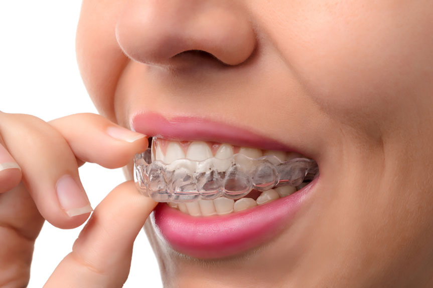 Invisalign Braces Treatment Abu Dhabi