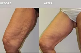 J Plasma for Thighs and Arms Abu Dhabi