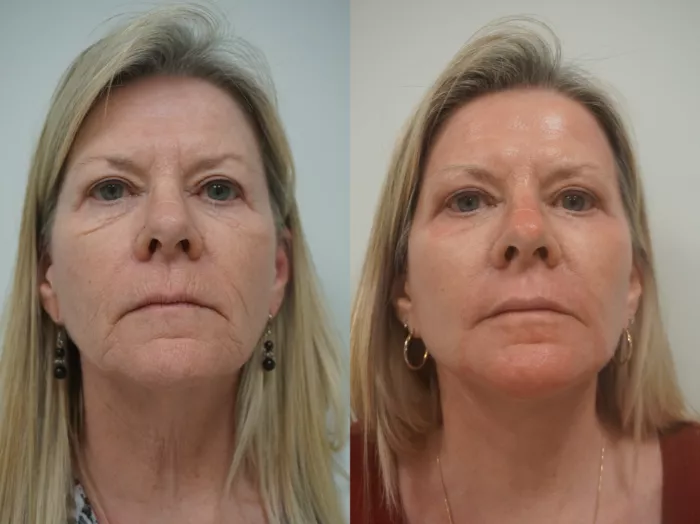 J Plasma Skin Resurfacing Abu Dhabi