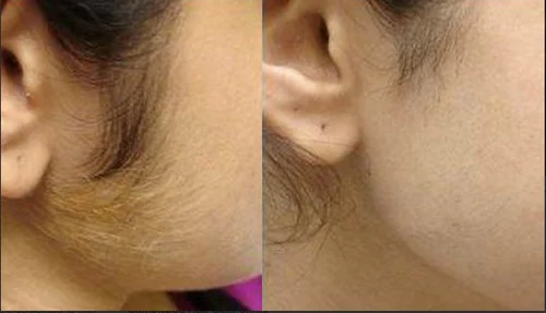 Laser Hair Bleaching Abu Dhabi