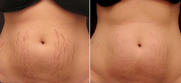 Stretch Marks Removal Abu Dhabi