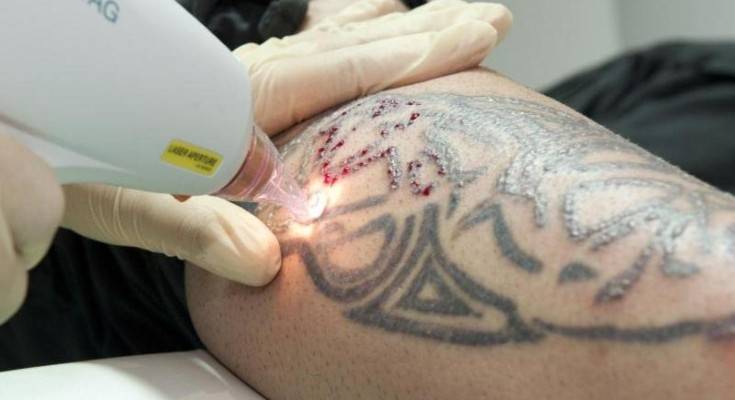 Laser Tattoo Removal Abu Dhabi