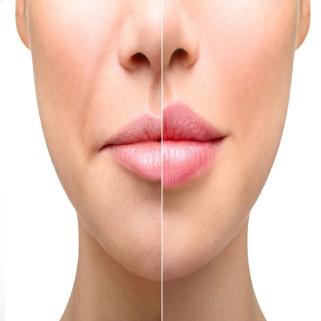 Lip Augmentation Abu Dhabi