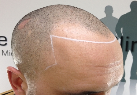 Natural Hairline Treatment Abu Dhabi