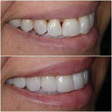 Non-Prep Veneers Abu Dhabi