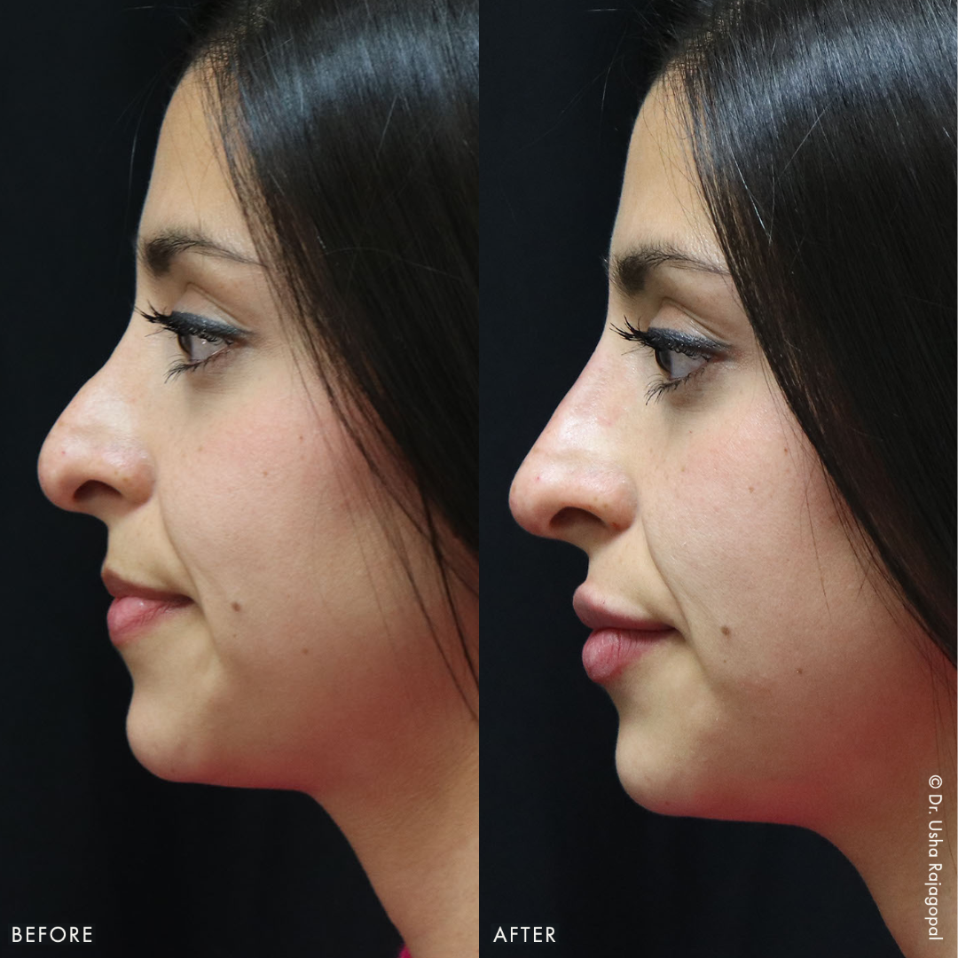 Non Surgical Nose Job Abu Dhabi