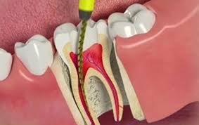 Root Canal Treatment Abu Dhabi