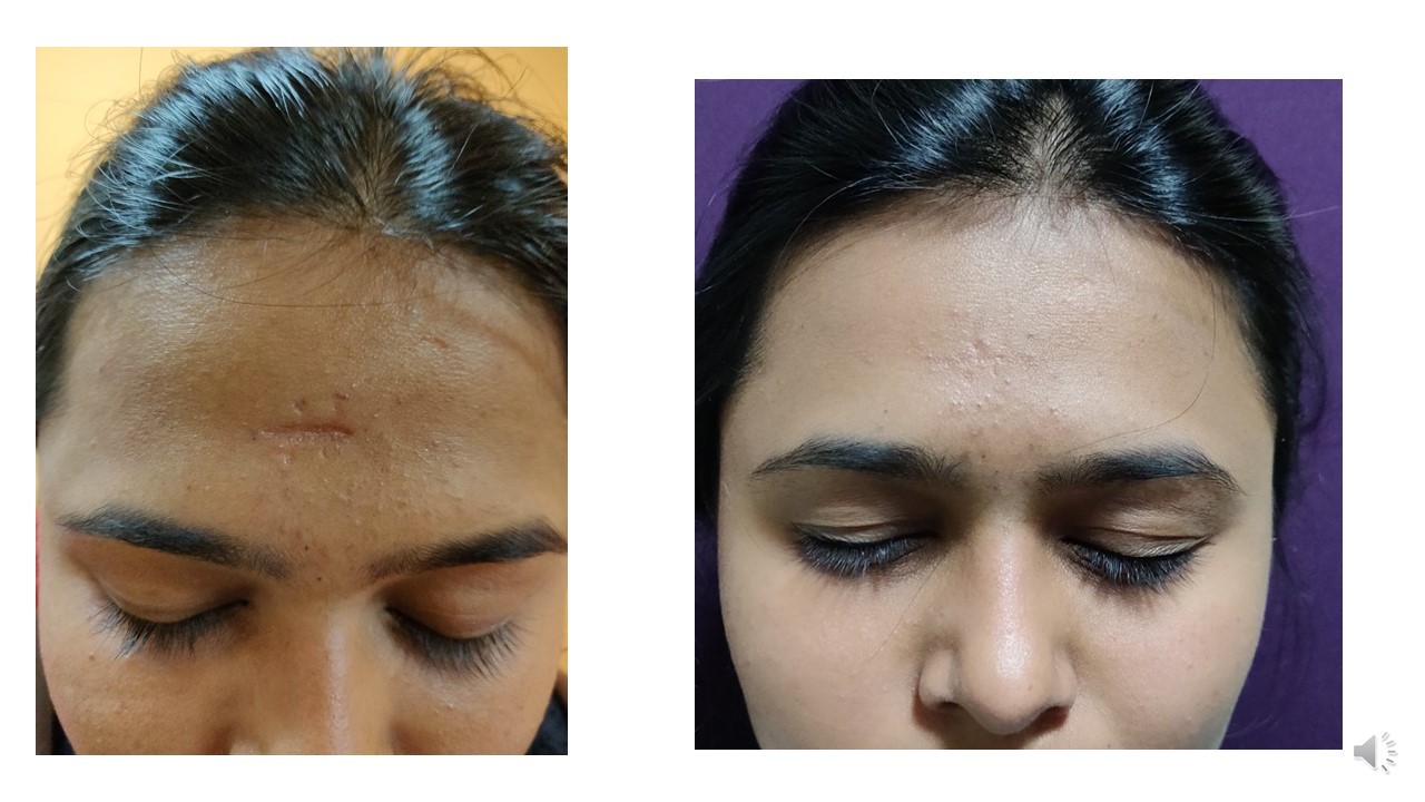 Facial Scar Revision Abu Dhabi