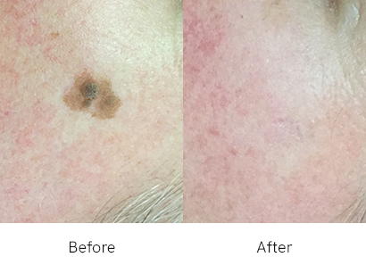 Seborrheic Keratosis Treatment Abu Dhabi