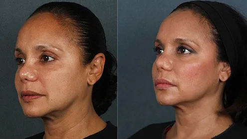 Silhouette Facelift Abu Dhabi