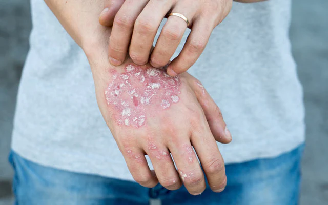 Skin Diseases Abu Dhabi