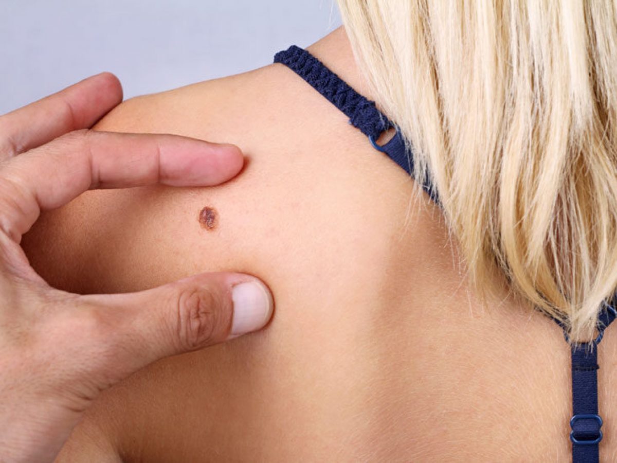 Skin Lesion Removal Abu Dhabi