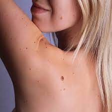 Skin Tag Removal Abu Dhabi