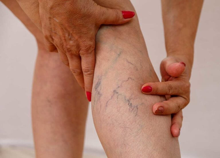 Spider Veins Treatment Abu Dhabi