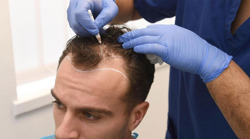 Stem Cell Hair Transplant Abu Dhabi